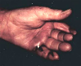Snake bite